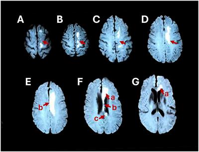 Case report: Symmetrical and increased lateral sway-based walking training for patients with corpus callosum infarction: a case series